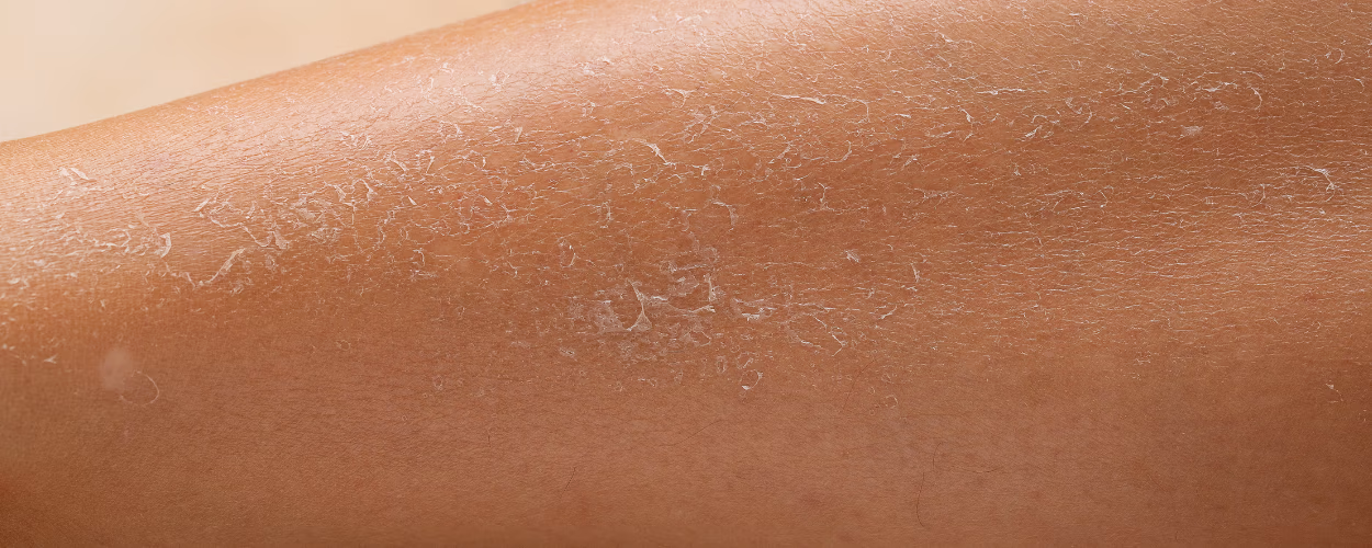dry skin, skin flakes, hydration, health, peau sèche, pellicules de peau, hydratation, santé,